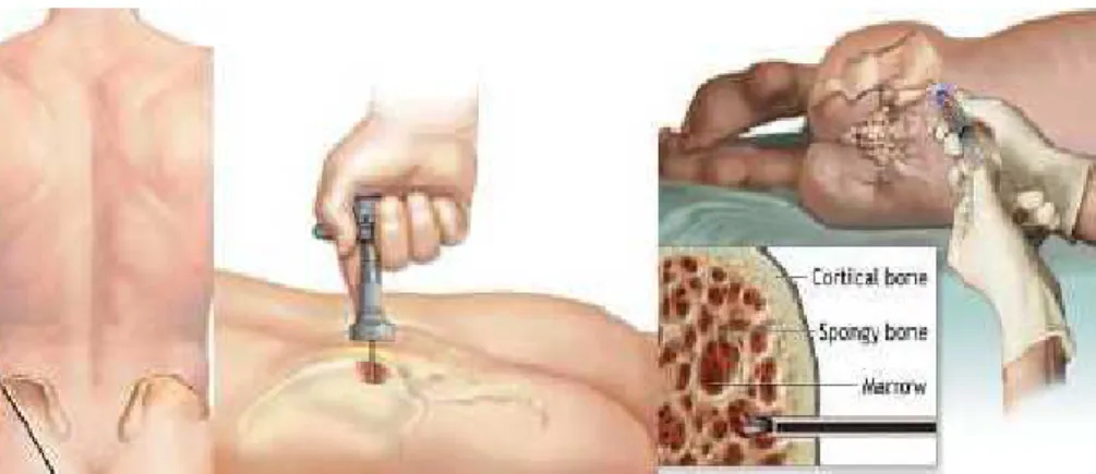 Figure  8:  Prélèvement  de  la  moelle  osseuse  au  niveau  des  crêtes  iliaques(66)