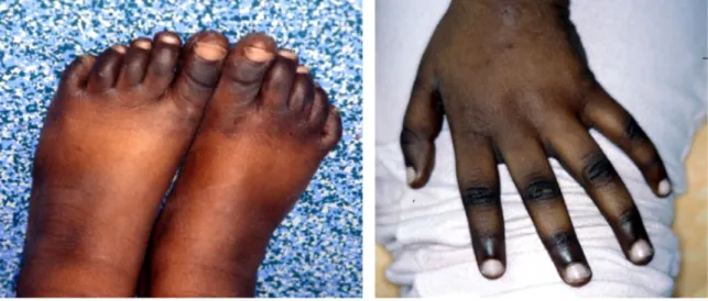 Figure 3 : hyperpigmentation cutané au niveau des mains et pieds [54] 
