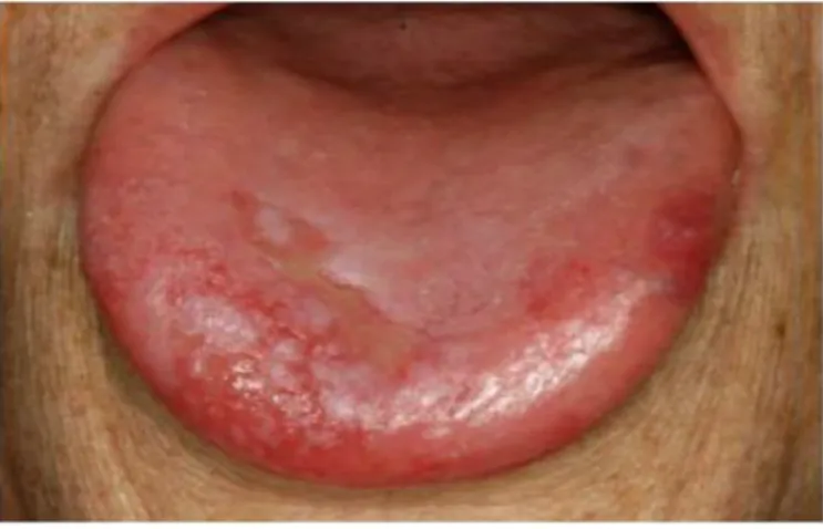 Figure 4 : face dorsale de la langue totalement dépapillée, avec des zones   érosives  ou ulcérées sur sa moitié antérieure [58] 