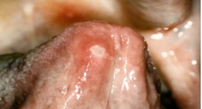 Figure 5 : Ulcérations aphtoïdes sur la face ventrale de la pointe de la langue et sur  le voile du palais [58]