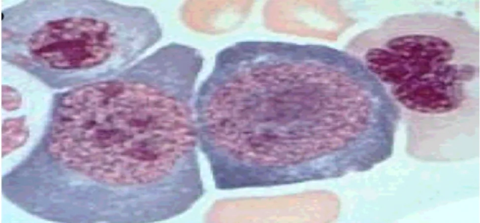 Figure 10 : présence d’une mégaloblastose médullaire [32] 