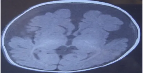 Figure 12 : coupe axiale chez une fille de 13 mois montrant un élargissement de la  fissure sylvienne avec une atrophie corticale [83] 