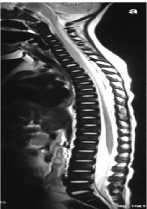 Figure 13: coupe sagittale pondérée en T2 montrant une hyper intensité au niveau  du cordon postérieur de la moelle épinière cervicale et dorsale jusqu’à D10 [48] 