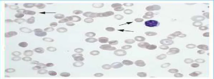 Figure 6 : Frottis de sang périphérique avec microsphérocytes. Dans l’AHAI, l’hémogramme  périphérique montre souvent des microsphérocytes (flèches)
