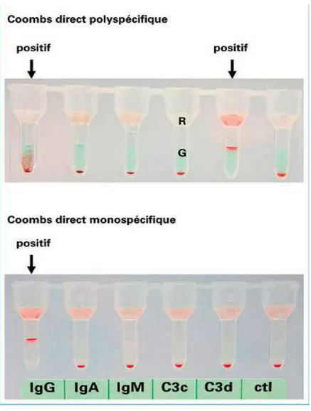 Figure 8 : Test de Coombs direct par la technique du gel. [1] 