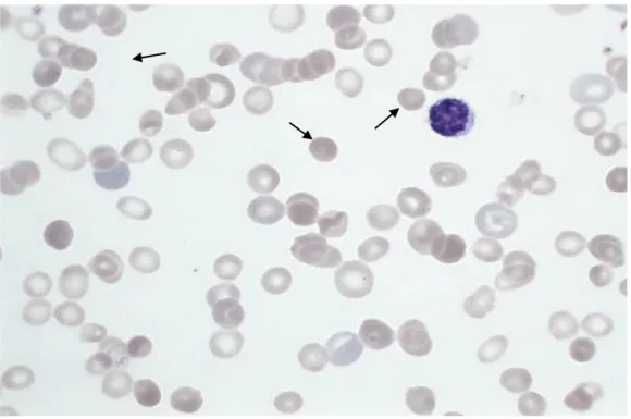 Figure 6 : Frottis de sang périphérique avec microsphérocytes :  