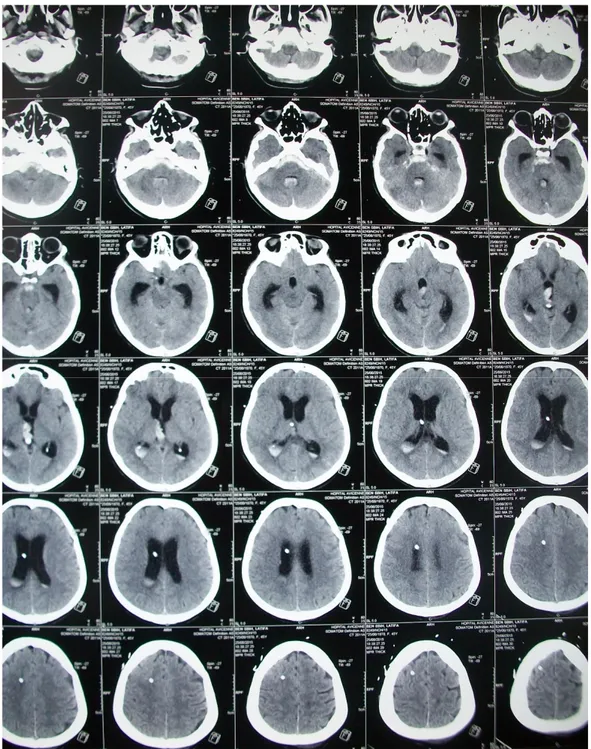 Figure 4 : TDM cérébrale de contrôle de la DVE. 
