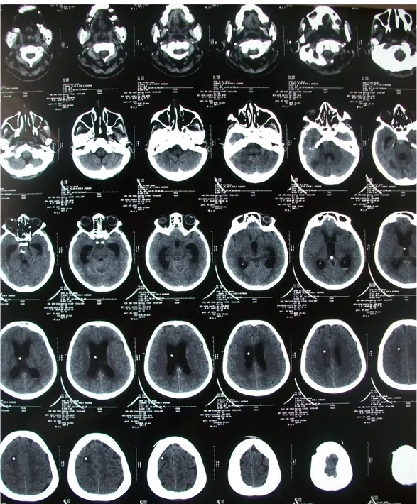 Figure 5 : TDM cérébrale de contrôle de la DVP. 