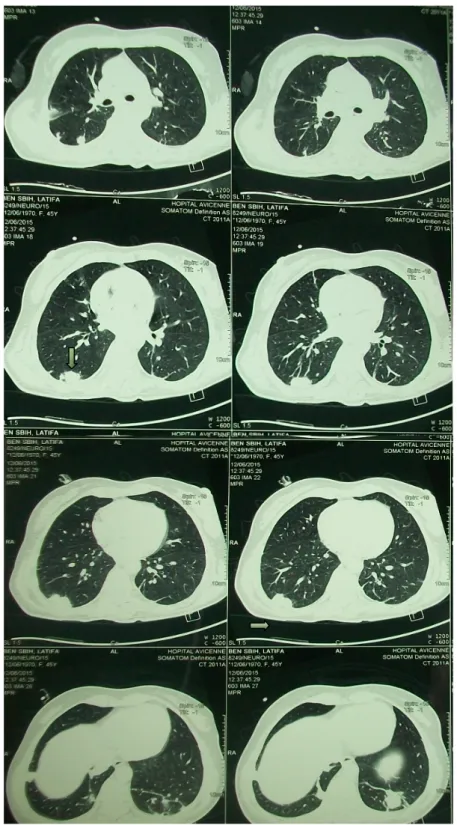 Figure 8 : Nodules pulmonaire évoquant des emboles septiques. 