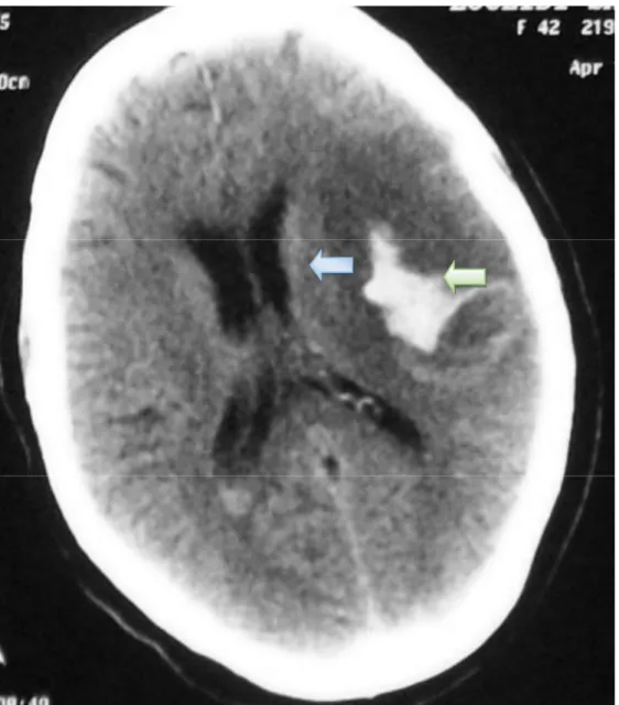 Figure 9 : TDM cérébrale C- montrant une hémorragie cérébro-méningée. 