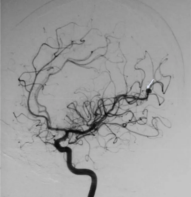 Figure 10: Artériographie cérébrale objectivant un  anévrysme distale   de l’artère cérébrale moyenne gauche