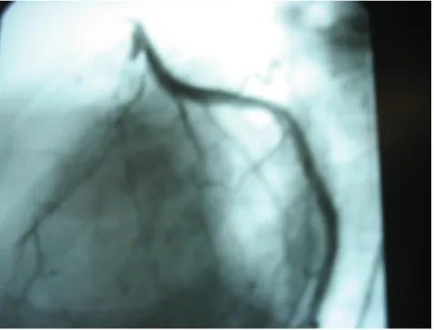 Fig. 8 : Occlusion de l’interventriculaire antérieure  et sténose de la circonflexe 