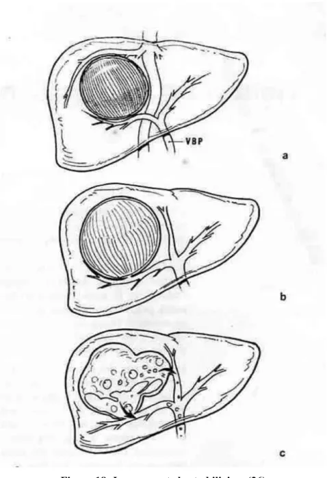 Figure 18: Les rapports kysto biliaires (36)  a.  Stade de compression 