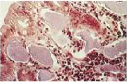 Figure 1: Coupe histologique d’une angiodysplasie. Les vaisseaux dilatés sont entourés  d’une paroi fine avec peu ou pas de couche musculaire lisse