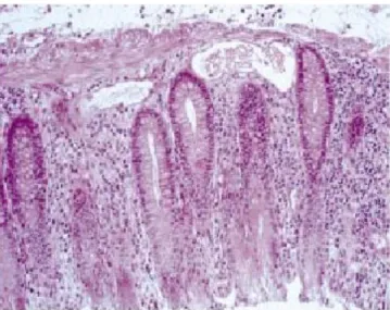 Figure 2: Angiodysplasie du colon  