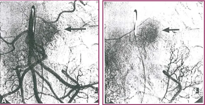 Figure 7 : artériographie sélective de l’artère mésentérique supérieure montrant une  lésion d’angiodysplasie (flèche) de la branche proximale de l’AMS