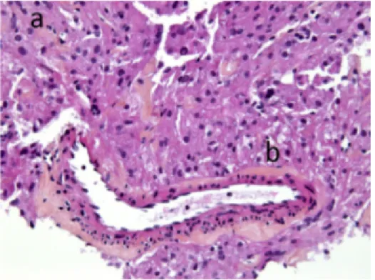Figure 7 : Coupe histologique d’angiomyolipome épithélioïde rénal à partir  de biopsies à l’aiguille fine