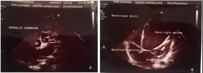 Figure 8 : Echocardiographie réalisée chez le patient 6 :  A : Coupe parasternale transversale : coronaire gauche nait de l’AP