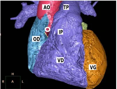 Fig. 34: Reconstruction scannographique montrant une connexion normale de l'artère coronaire  droite (cercle blanc) [27]