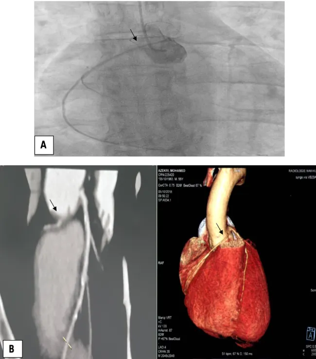 Fig. 10 : A. Image angiographique d’une naissance ectopique de l’artère coronaire droite à  partir du sinus antérogauche (flèche) 