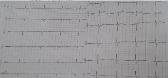 Fig.  18 :  Electrocardiogramme montrant les ondes T négatives en inférieur et plates et  en latéral bas 