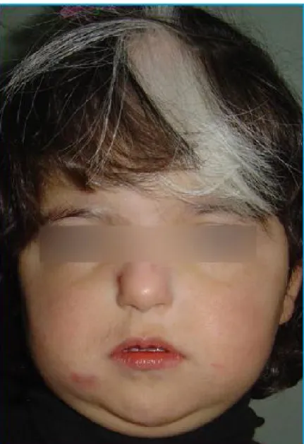 Figure 5 : Poliose 