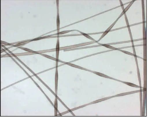 Figure 7 : Monilethrix : nodosités uniformes et rétrécissements 