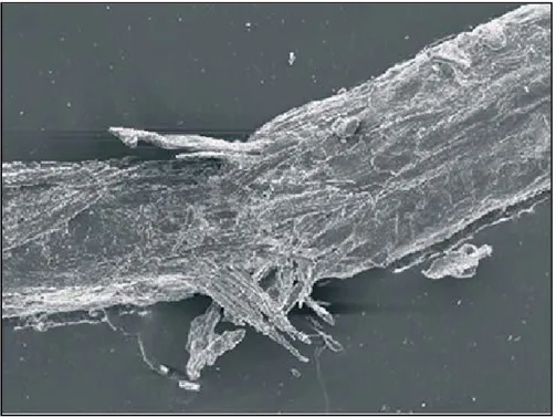 Figure 10 : Trichorrhexie noueuse en ME. [21] 