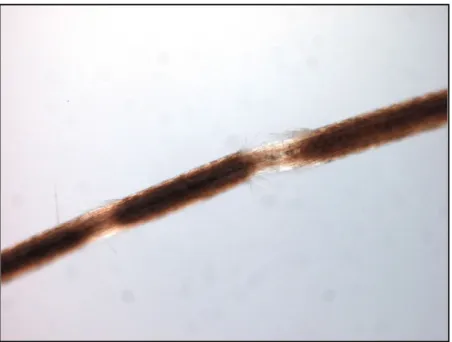 Figure 11 : Trichorrhexie noueuse [22] 
