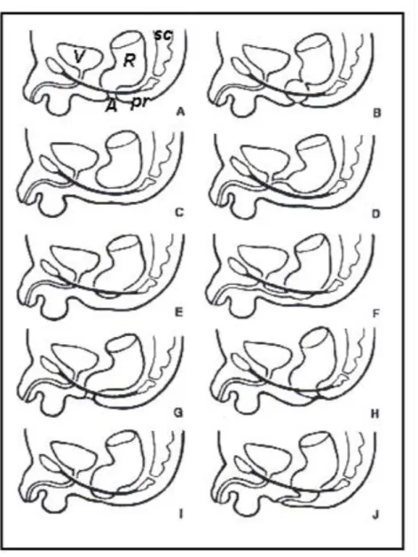 Figure 10: Les différents types anatomiques d’imperforation ano-rectale dans le sexe  masculin (42)