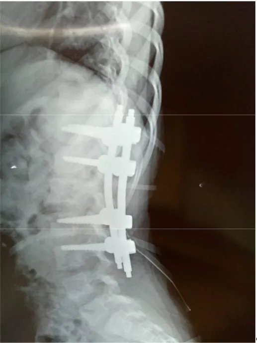 Figure 4: Radiographie du rachis lombaire (F+P) avec matériel d’ostéosynthèse en place  (HMIMV) 