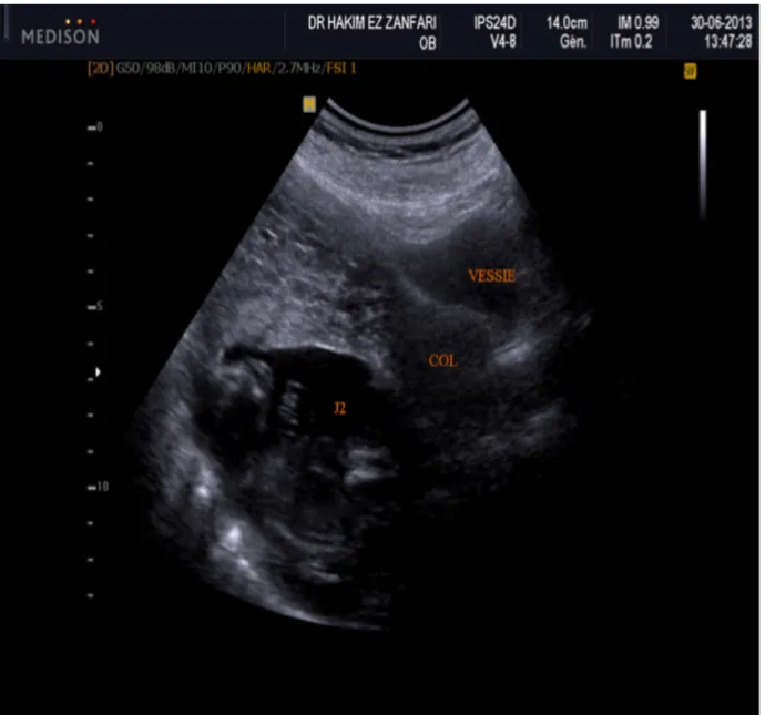 Figure 3: Echographie sus-pubienne à 15 SA montrant l’emplacement   du deuxième fœtus par rapport au col utérin