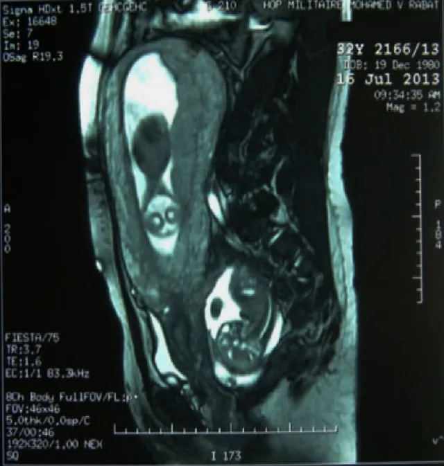 Figure 5: IRM à 19 SA montrant une grossesse intra-utérine et une grossesse ectopique ainsi  que les rapports placentaires du fœtus B avec les organes pelviens