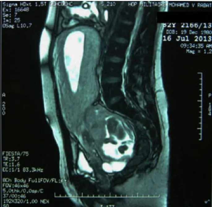 Figure 6: : IRM à 19 SA montrant une grossesse intra-utérine et une grossesse ectopique  ainsi que les rapports placentaires du fœtus B avec les organes pelviens