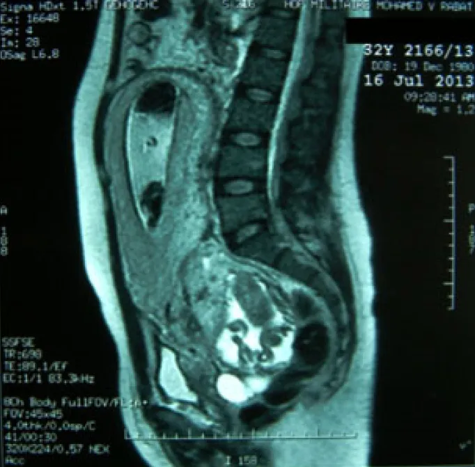 Figure 7: IRM à 19 SA montrant une grossesse intra-utérine et une grossesse ectopique ainsi  que les rapports placentaires du fœtus B avec les organes pelviens