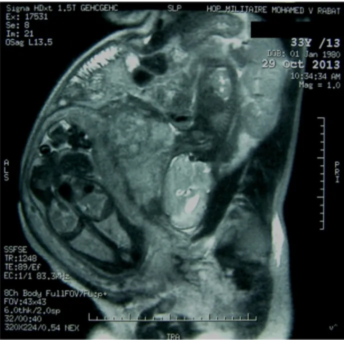 Figure 8: IRM abdomino-pelvienne à 32 SA (coupe sagittale). 