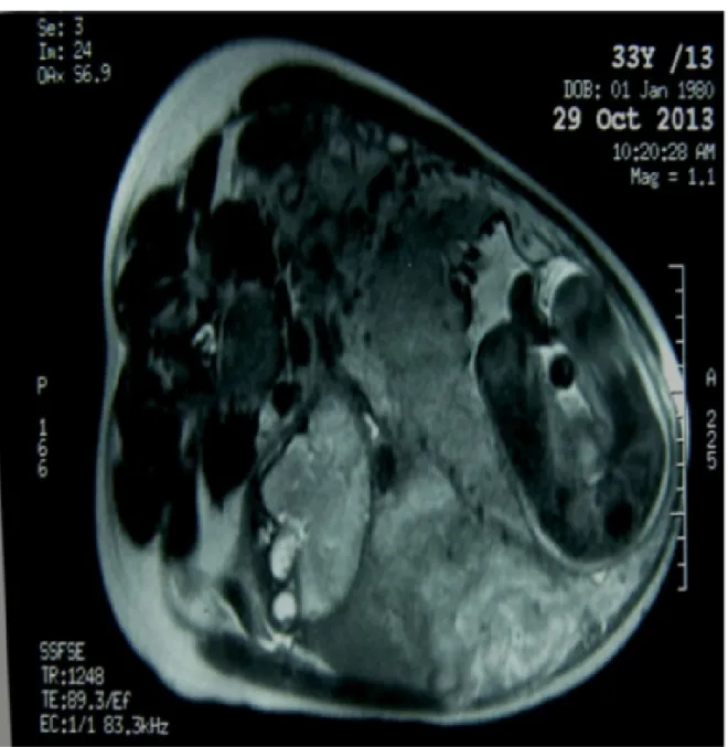 Figure 9: IRM abdomino-pelvienne à 32 SA montrant le fœtus ectopique   et ses rapports placentaires avec les viscères (coupe transversale)