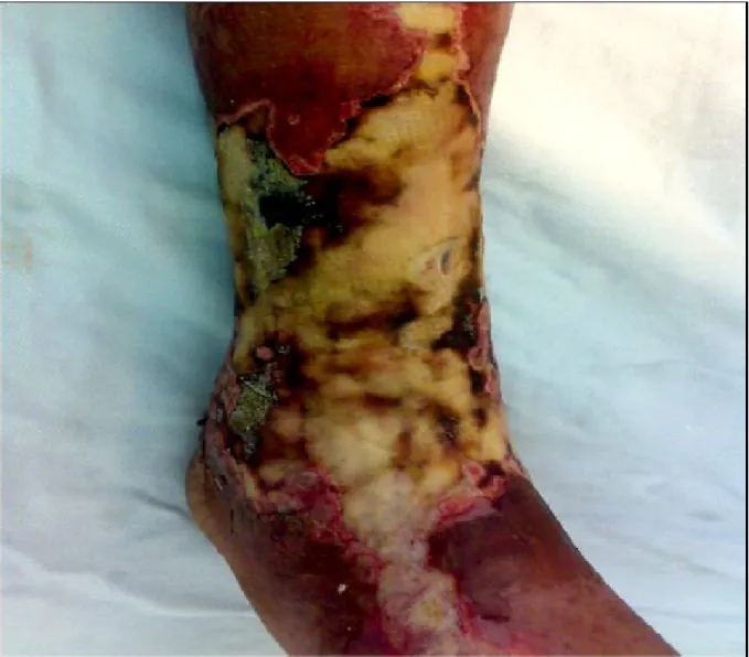 Figure 6: fasciite nécrosante de la jambe et de la cheville chez un patient diabétique 