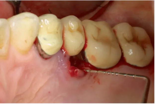 Figure 12 : Abcès parodontale localisé au niveau d'une prémolaire maxillaire [23] 