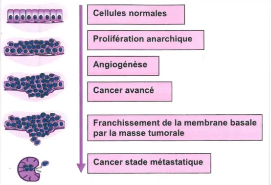 Figure 1 : la cinétique ou chronologie de l’évolution tumorale. 