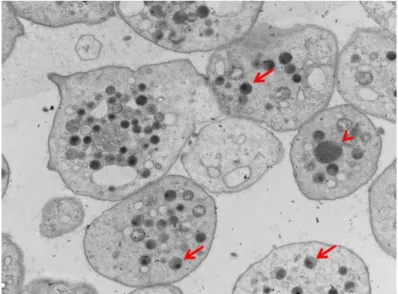 Figure 3 : image en microscopie électronique à transmission montrant de gros granules  alpha dans le syndrome de Jacobsen [20]