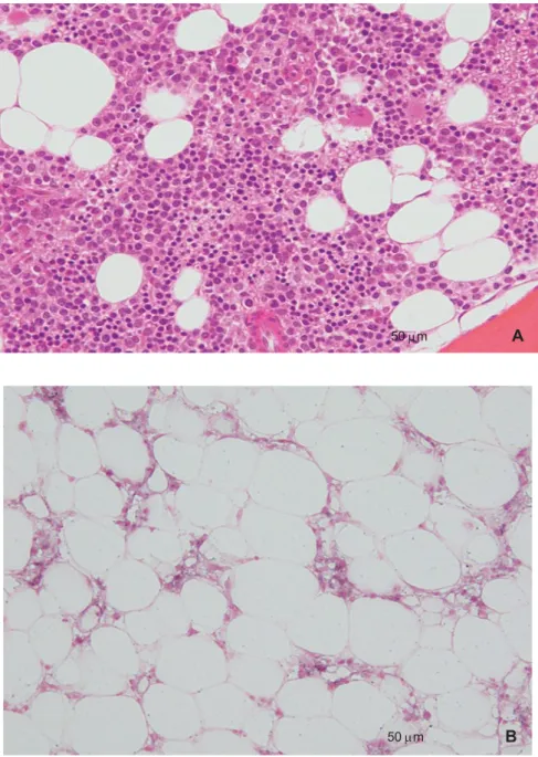 Figure n°5 :  Biopsie ostéomédullaire de moelle normale (A)   et de moelle d’aplasie médullaire (B)  [2] 