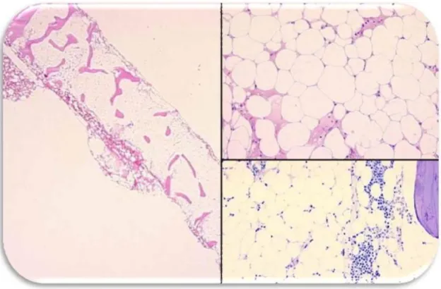 Figure 5: Aspect histologique d’une aplasie médullaire [57].  