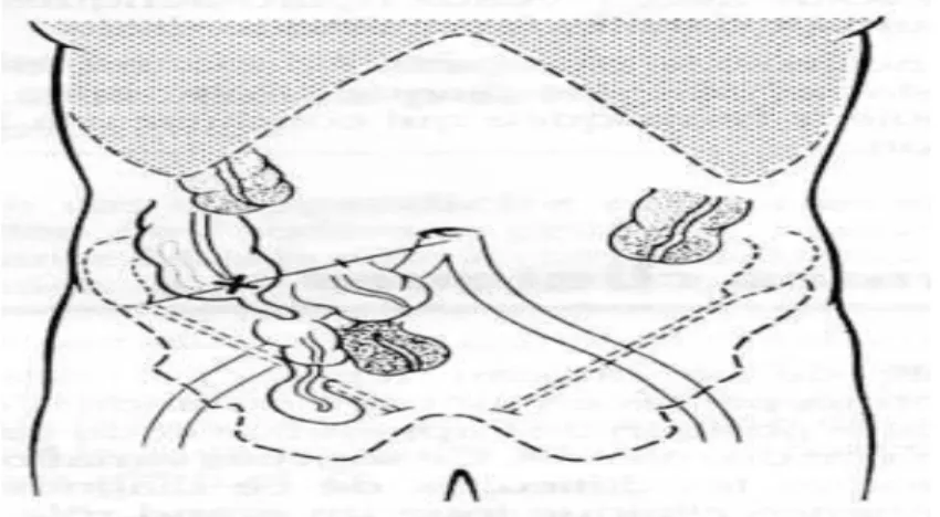 Figure 3 : les formes topographiques de l’appendice 