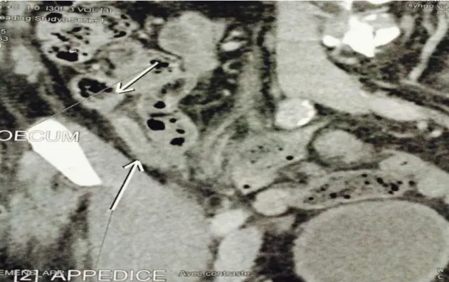 Figure 8 : image de scanner abdomino-pelvien montrant une appendicite  aigue (Source : chirurgie viscérale HMIMV-Rabat)