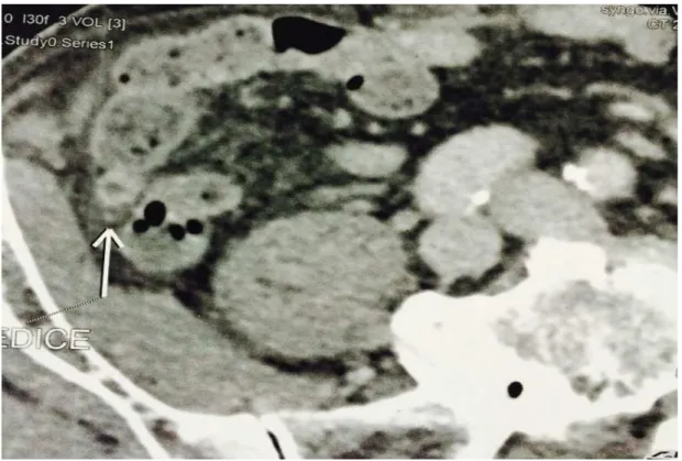 Figure 9 : image de scanner abdomino-pelvien montrant une appendicite  aigue (Source : chirurgie viscérale HMIMV-Rabat)
