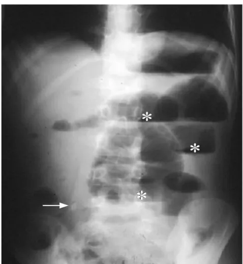 Figure 9 : Radiographie d’abdomen sans préparation avec un stercolithe (flèche) et des  niveaux hydroaériques (astérisques) d’occlusion intestinale chez un enfant ayant une 