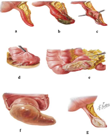 Figure 15 : Des maladies de l’appendice [5] 