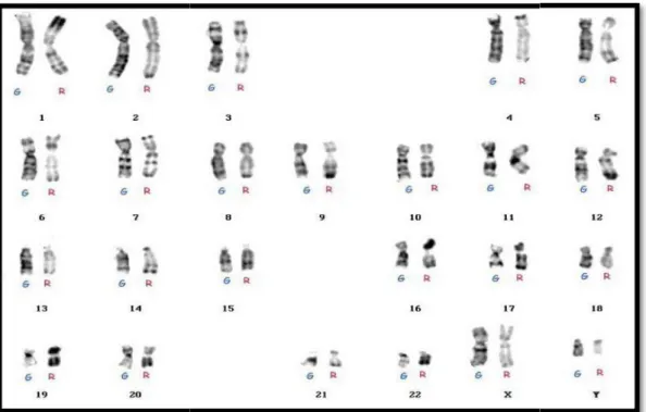 Figure 6: caryotype humain normal (46, XY) en bande G et R. [28]