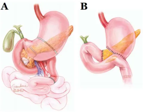 Figure 2 Pancreaticoduodenectomy (Whipple’s procedure). The anatomical locations for resection (A) and reconstruction  (B)